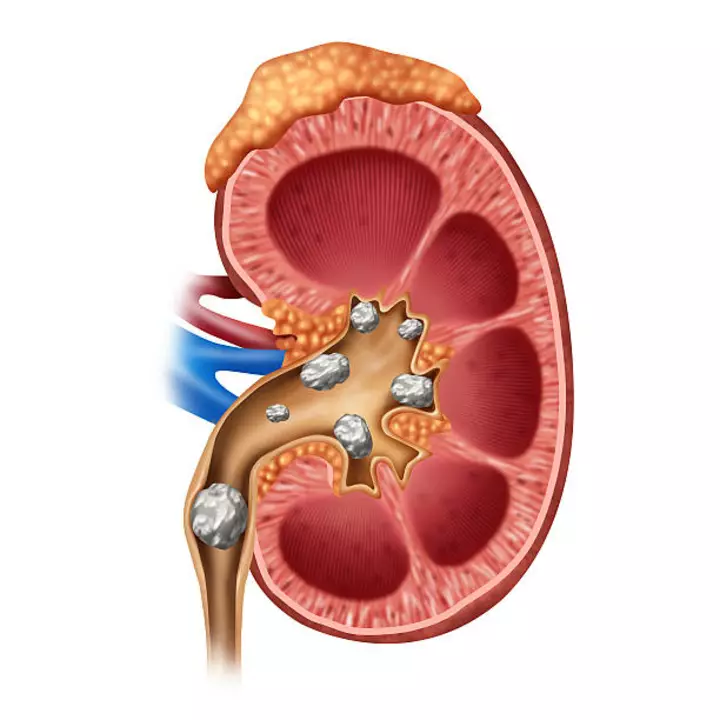 Kidney stone successful treatment uploaded by DR. SHIVENDRA YADAV on 8/8/2022