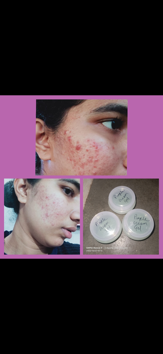 Ayurvedic Pimples gel  uploaded by business on 2/13/2023