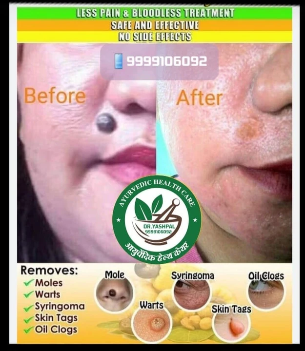 Wart remover  uploaded by DR.YASHPAL HEALTH CARE on 2/28/2023