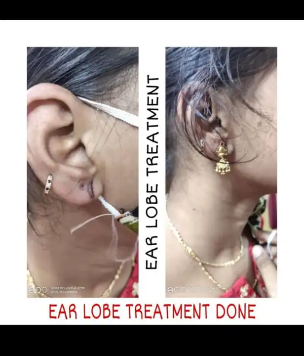 Earloop treatment  uploaded by business on 3/24/2023