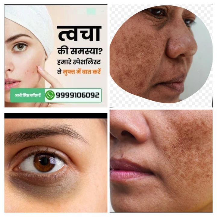 Heigh pigmentation  uploaded by DR.YASHPAL HEALTH CARE on 4/5/2023