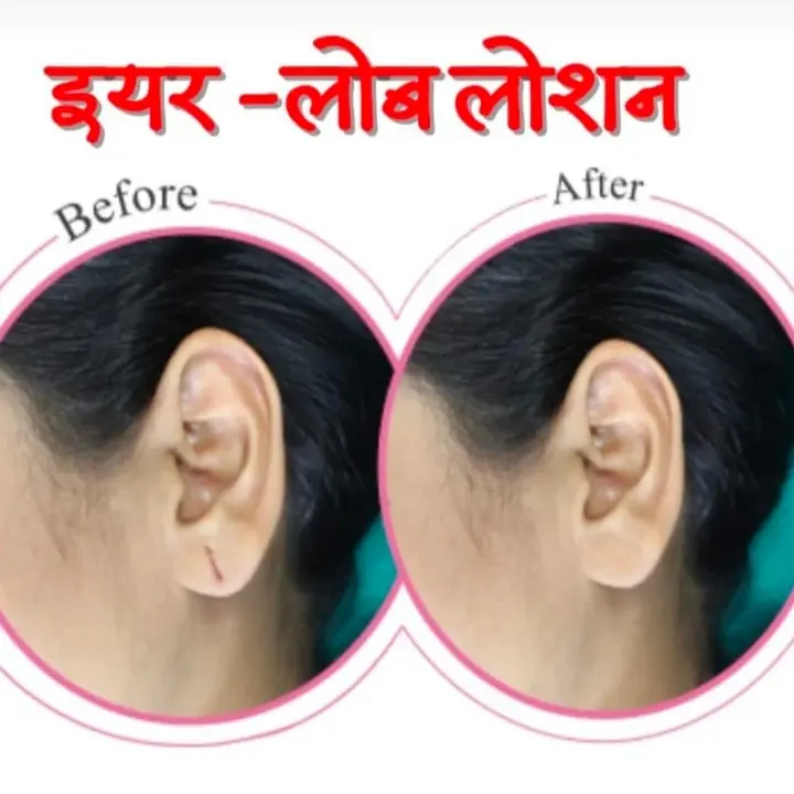 EAR LOBE PRODUCT 3000 MRP AFTER DISCOUNT 2000 uploaded by business on 7/30/2023