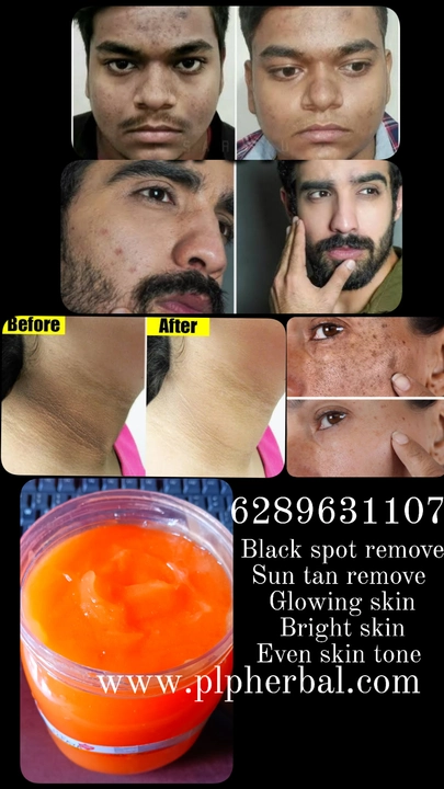 Post image @followers 
🧡 PLP Herbal Papaya Gel and scrub
❤️ We are manufacturer WhatsApp 062896 31107 ✅✅ 100 % pure organic product.
❌❌ No side effects. 
✅ remove dark spots and dark patches
✅ Even skin tone
✅ Brighten and lighten skin tone
✅ Remove dead cell
✅ Glowing white, younger and bright skin.

#ClearSkinGoals #GlowingComplexion #RadiantSkin #HealthySkin #SkinCareRoutine #FlawlessBeauty #SkincareTips #SpotlessGlow #PureRadiance #NourishedSkin #HealthyGlow #NaturalBeauty #SkincareEssentials #DermatologyTips #ClearComplexion #BeautifulSkin #DailySkincare #SkincareRegimen #PamperYourSkin #BeautyFromWithin.