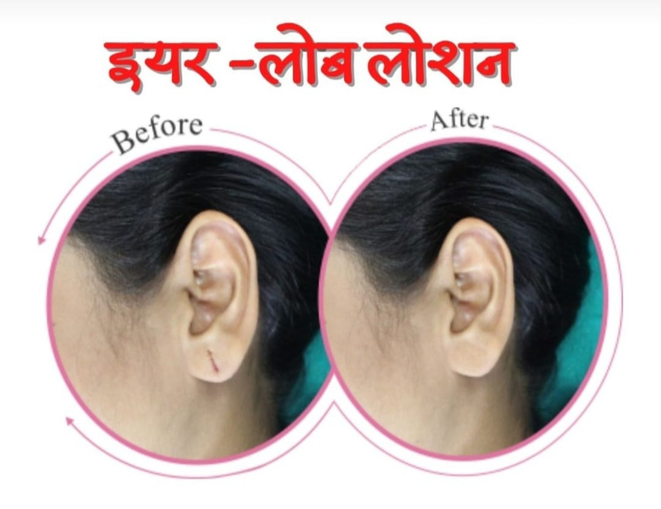 EAR LOBE REPAIRING LOTION  uploaded by COSMO AIR BRUSH MACHINE on 3/9/2024