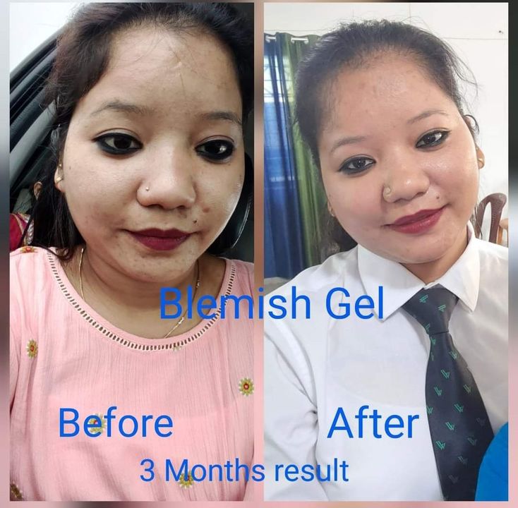 Blemish gel uploaded by business on 9/5/2021