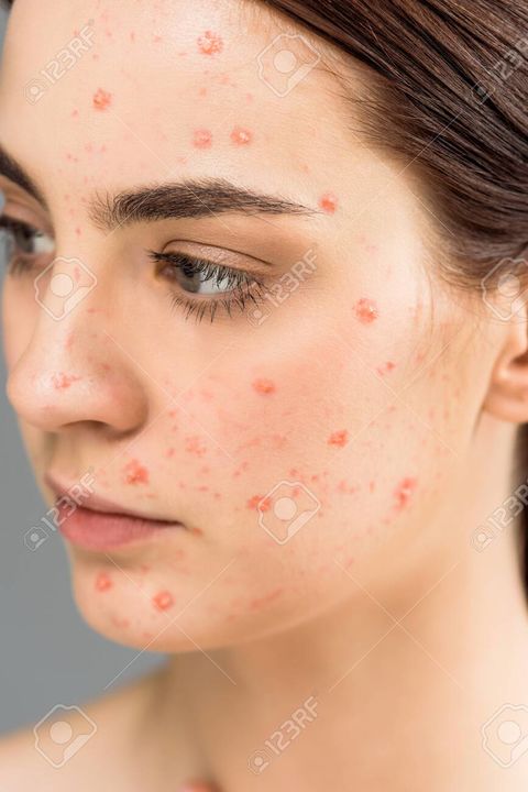 Pimples and blemish  problem uploaded by business on 10/13/2021