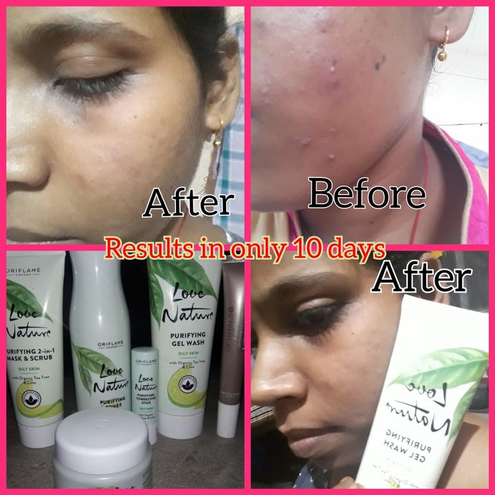 Pimples uploaded by Swathi Enterpenuer on 11/3/2021