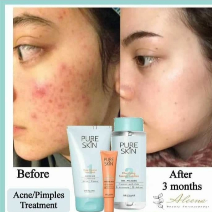 Post image For acne an pimple