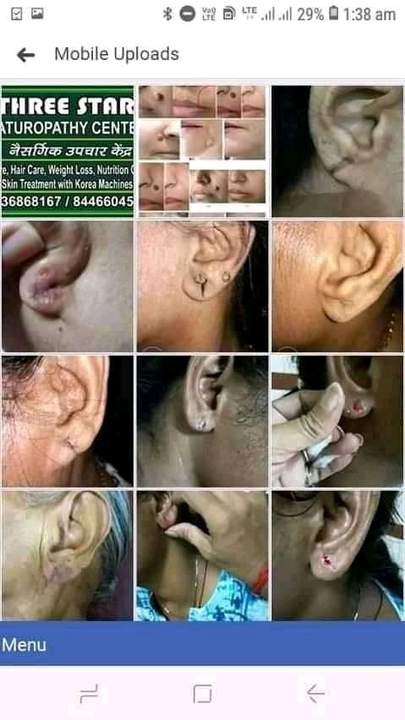 Ear Lobe repair without surgery  uploaded by Three star naturopathy centre on 6/17/2022